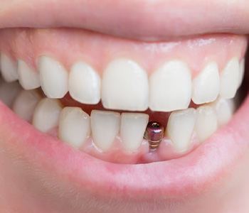 Smile with dental implant