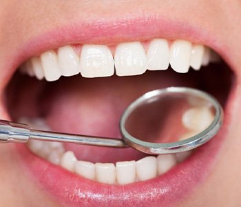 Close up of dental mirror examining a patient’s smile