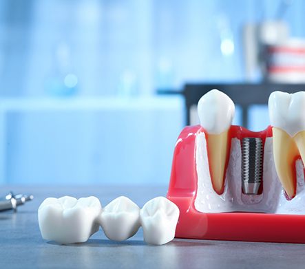 Thumb and forefinger grasping a dental bridge