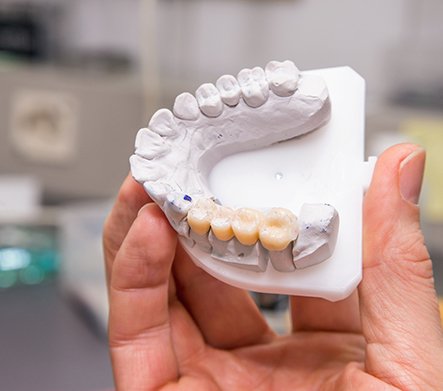 Dental bridge and crown on desk in front of model dental implant
