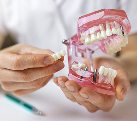 Hand holding cast of arch of teeth containing dental bridge