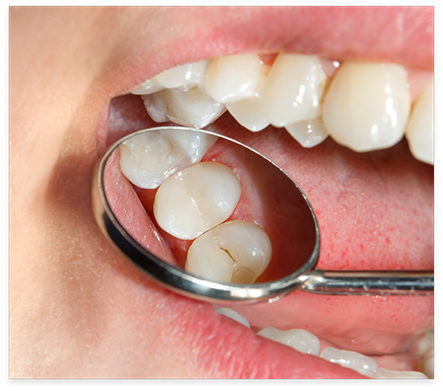 Close up of dental mirror inside of mouth