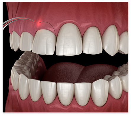 Illustrated dental laser correcting a gummy smile