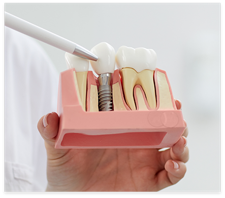 Dentist gesturing to a model of a dental implant in Nocatee