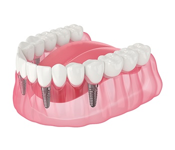 Illustration of implant denture
