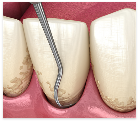 Illustrated dental scaler cleaning plaque buildup during gum disease treatment