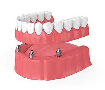 Lower arch of dentures next to clear base with several dental implants