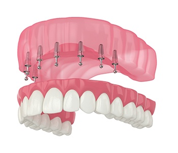 Rendering of lower arch of implant dentures with white background