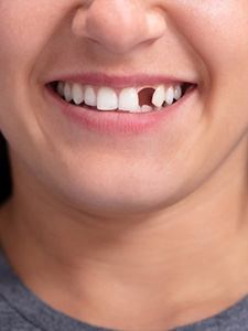 I Am Worried About Bleeding Gums