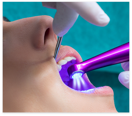 Dental patient having dental sealants applied to their teeth