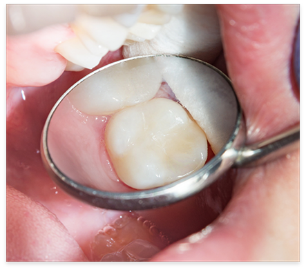 Close up of dental mirror in mouth reflecting a tooth