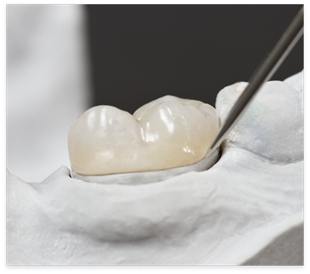 Close up of a dental inlay covering a model of a tooth