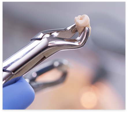 Dental forceps holding an extracted tooth