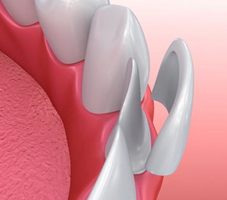 A porcelain veneer