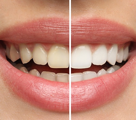 Side-by-side image of stained and whiter teeth