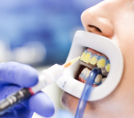 Patient receiving in-office teeth whitening