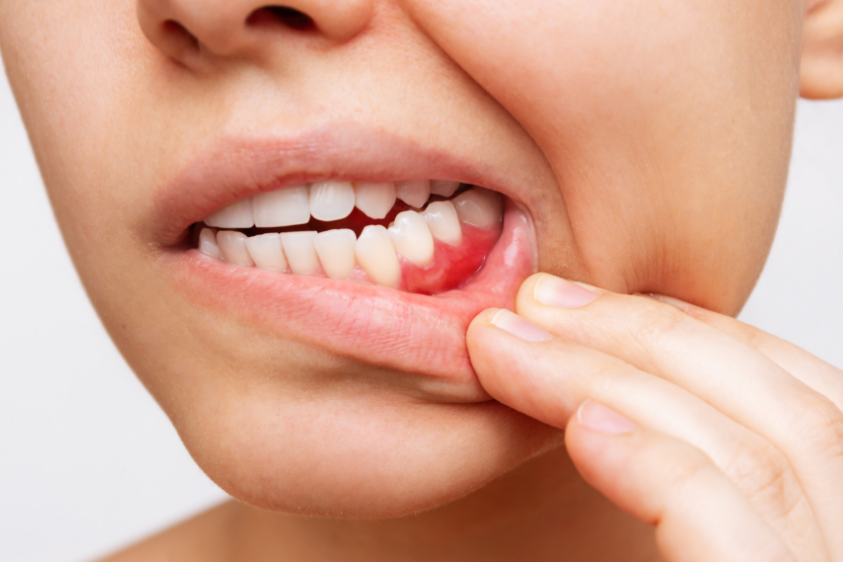 Woman showing irritated gums
