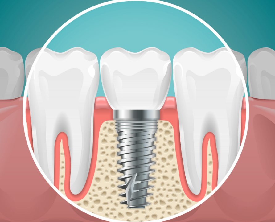 Illustration of a dental implant